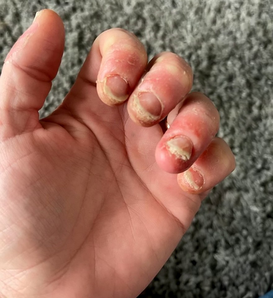 But her fingers started feeling inflamed and itchy and the nails started peeling off