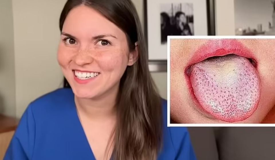 A dark red tongue with prominent bumps could be a symptom of a 'serious illness'