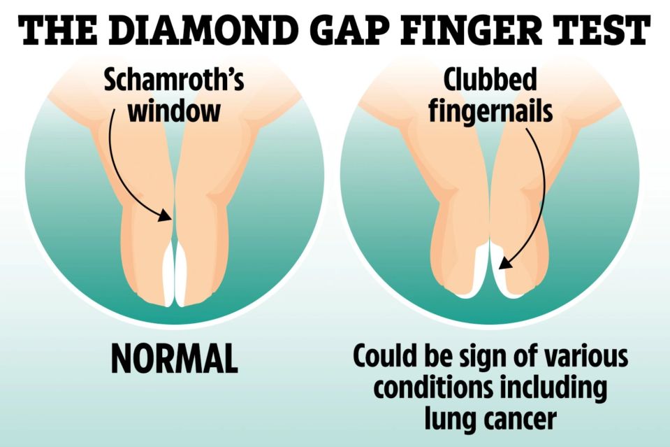 The 'diamond gap' fingernail test can indicate whether you have finger clubbing