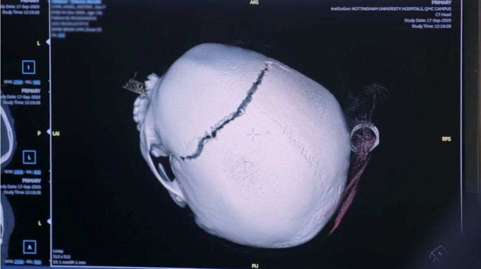 Horrifying CT scans reveal how Angel's skull was fractured from top to bottom following the horror