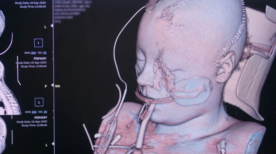 Shocking CT scans show trauma across Angel's head