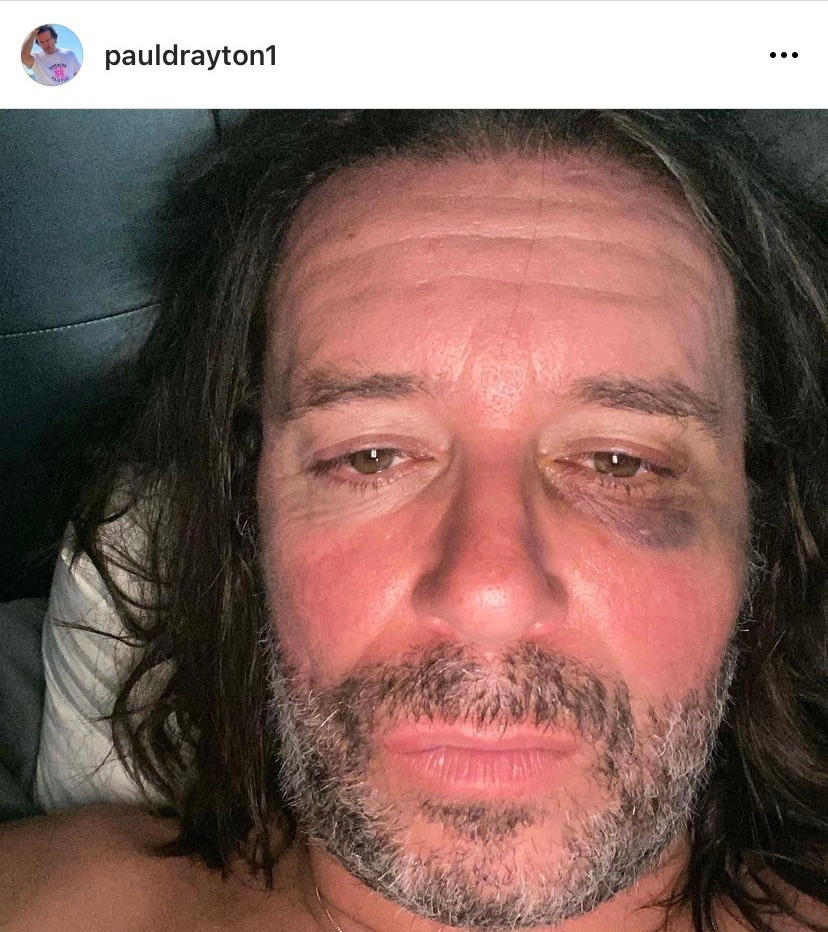 Fans assumed he was accusing Alan of domestic abuse after he posted a Instagram picture of his bruised face