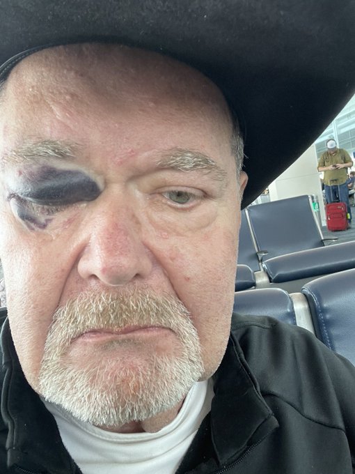 AEW commentator Jim Ross left fans concerned as he showed off a black eye from a 'bad fall'