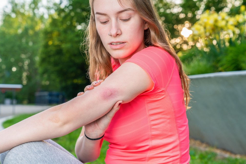 As shown above, mosquito bites will usually be red around the area that has been bitten