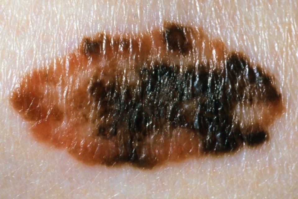 Melanomas can be a combination of more than one or two colours