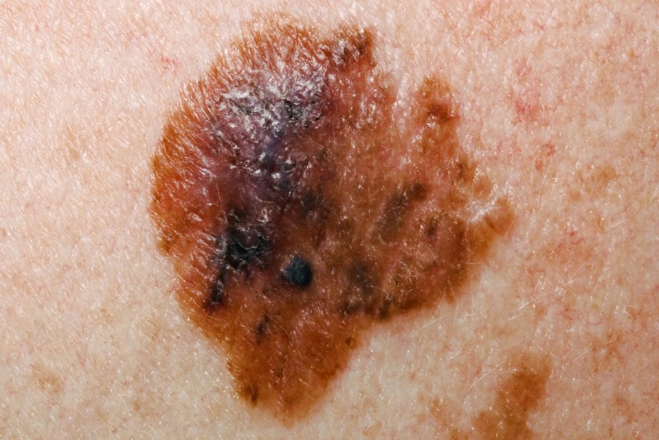 Melanomas are often an uneven shape