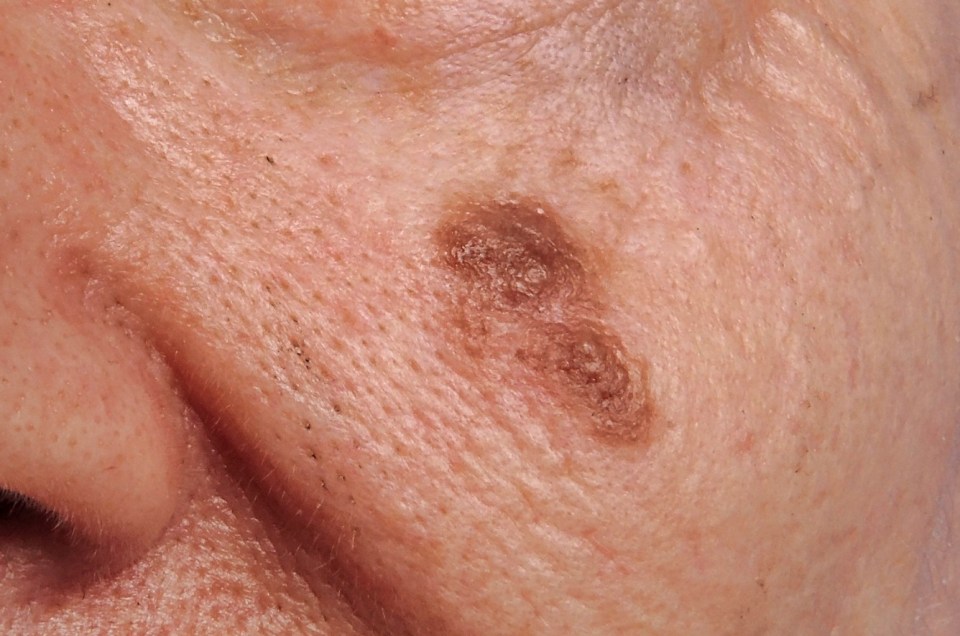 Normal moles are usually small, whereas melanomas tend to be bigger