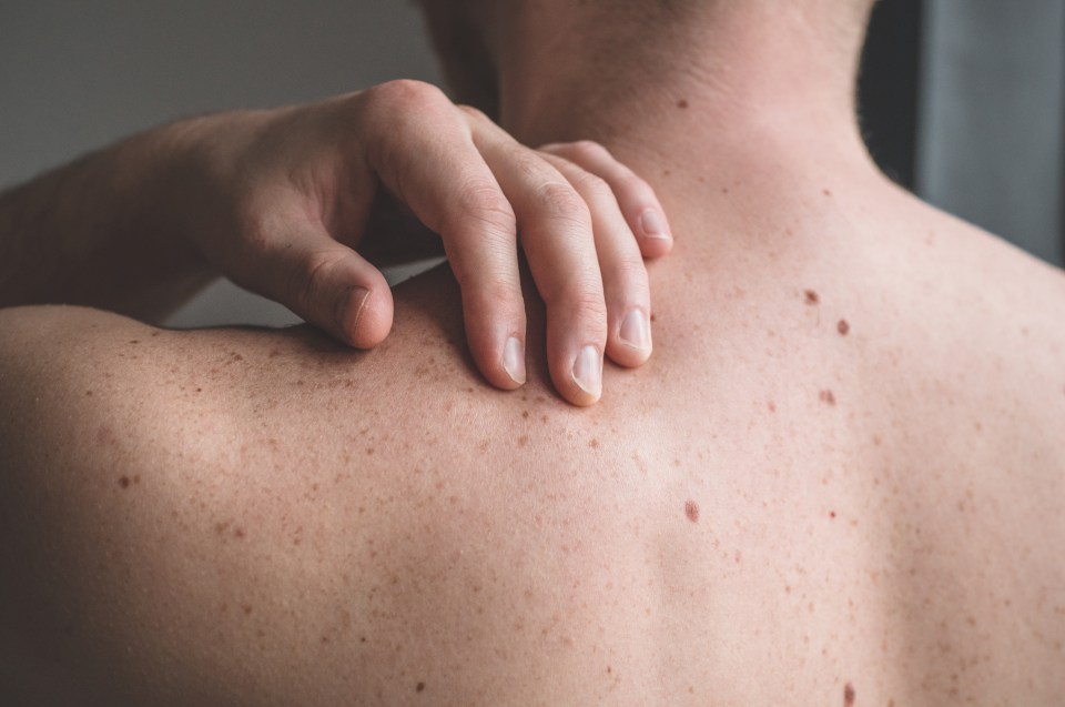 Mole changes could be a sign of skin cancer, a GP has warned