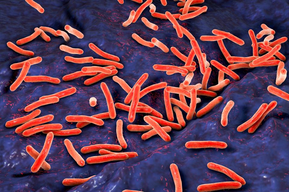 Tuberculosis appears to be overtaking Covid as the world's most deadly infectious disease