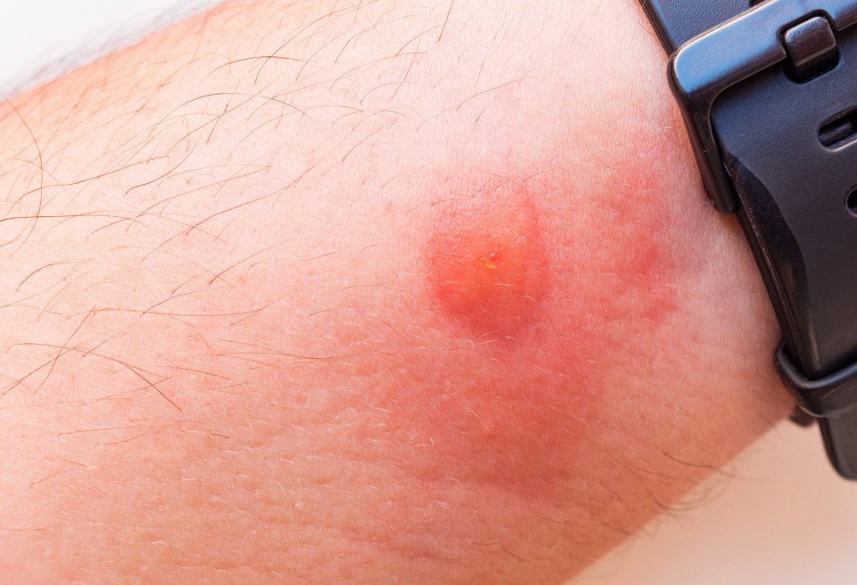 The painful bites can spread dangerous infections and be resistant to antibiotics