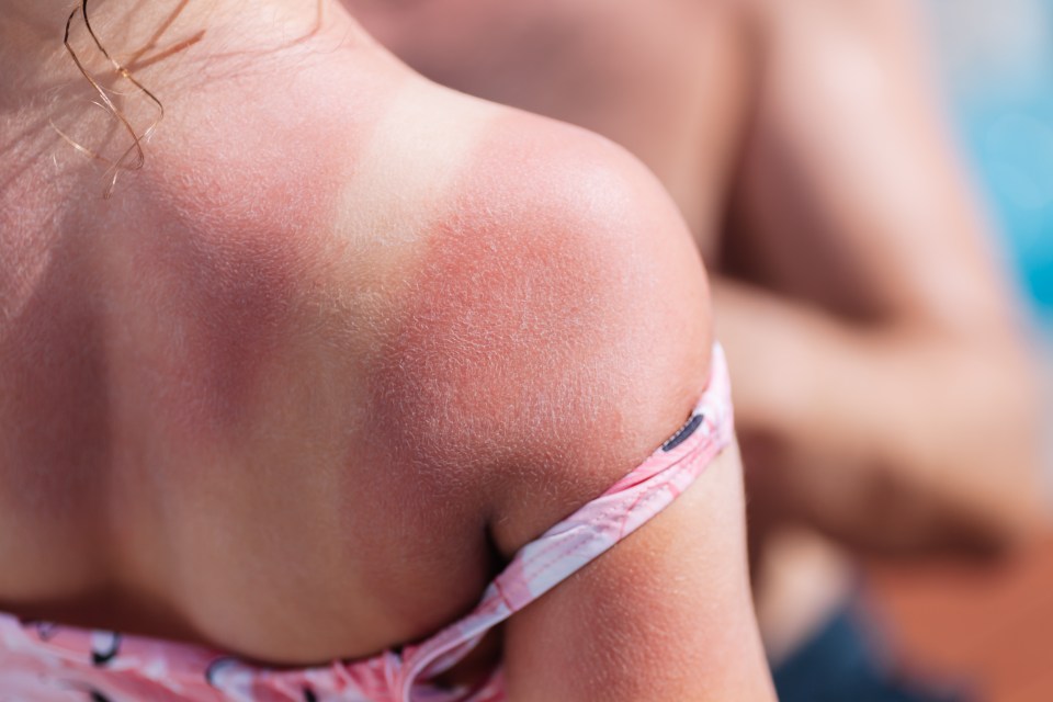 Caught the sun? Once your burn has healed, coconut oil can help reduce scarring