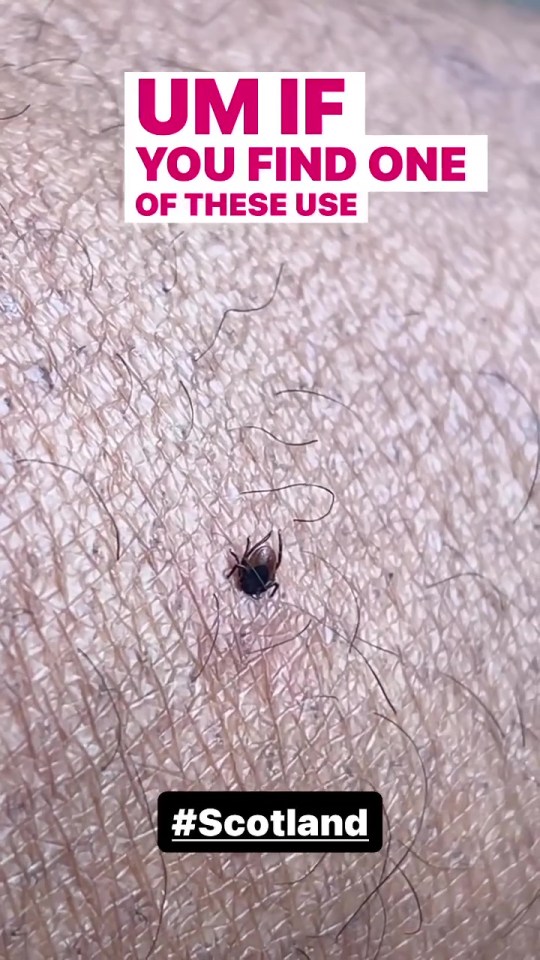 A live tick had embedded itself into the former Strictly star's skin