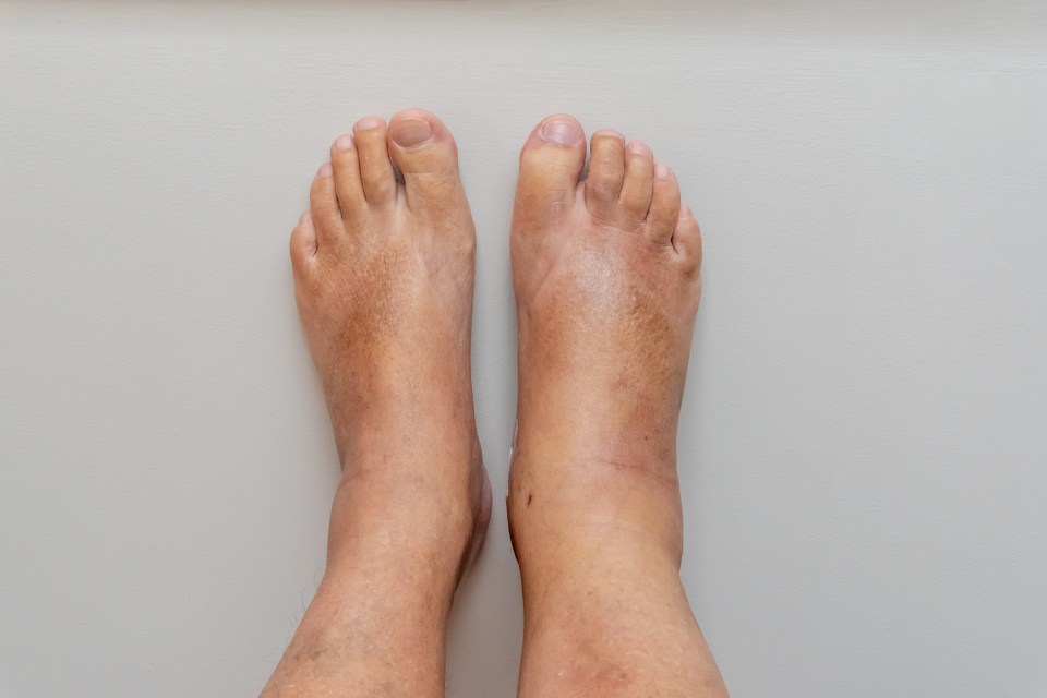 Also known as oedema, this can cause our feet, ankles and legs to swell