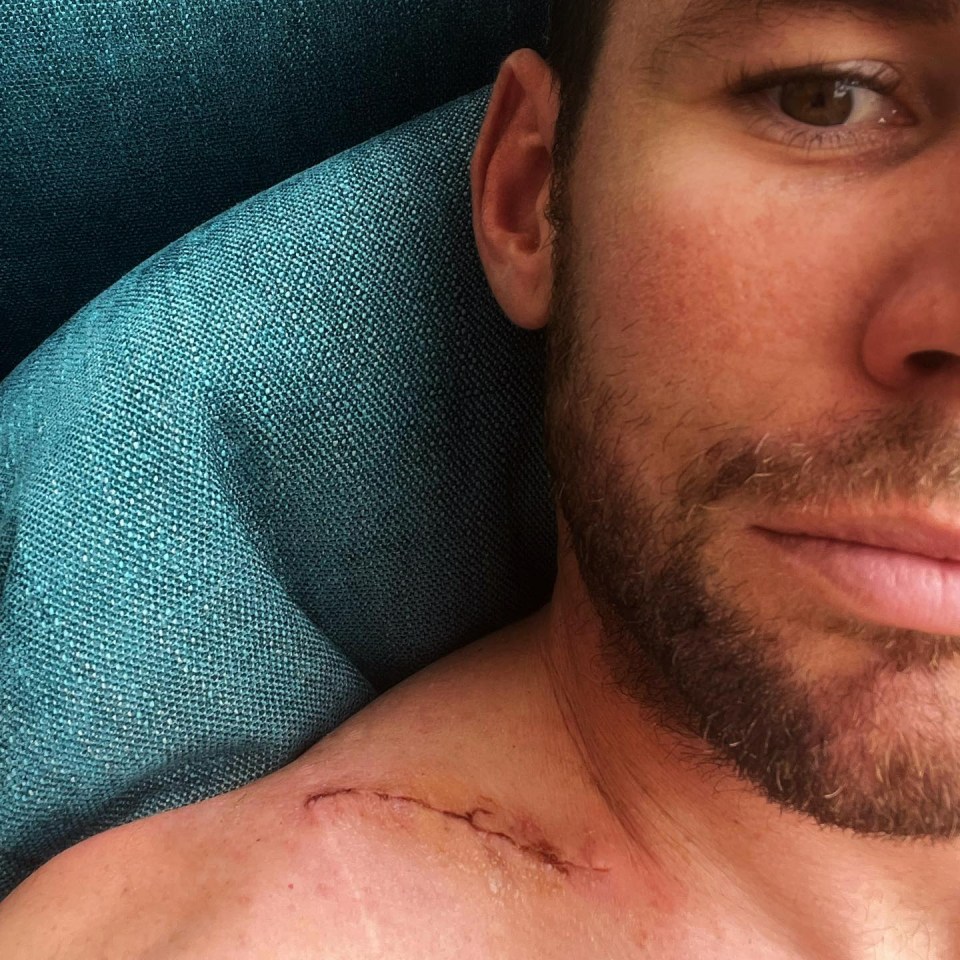 Mark Cavendish has shown off his gruesome scar from surgery