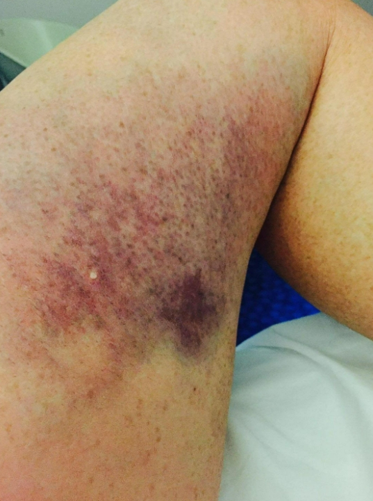 Bev claimed she suffered bruises after appearing on Cannonball