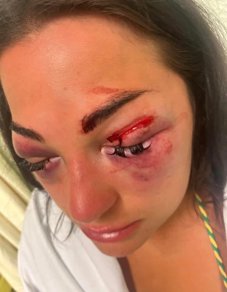 She says she was left with two broken eye sockets and a fractured nose