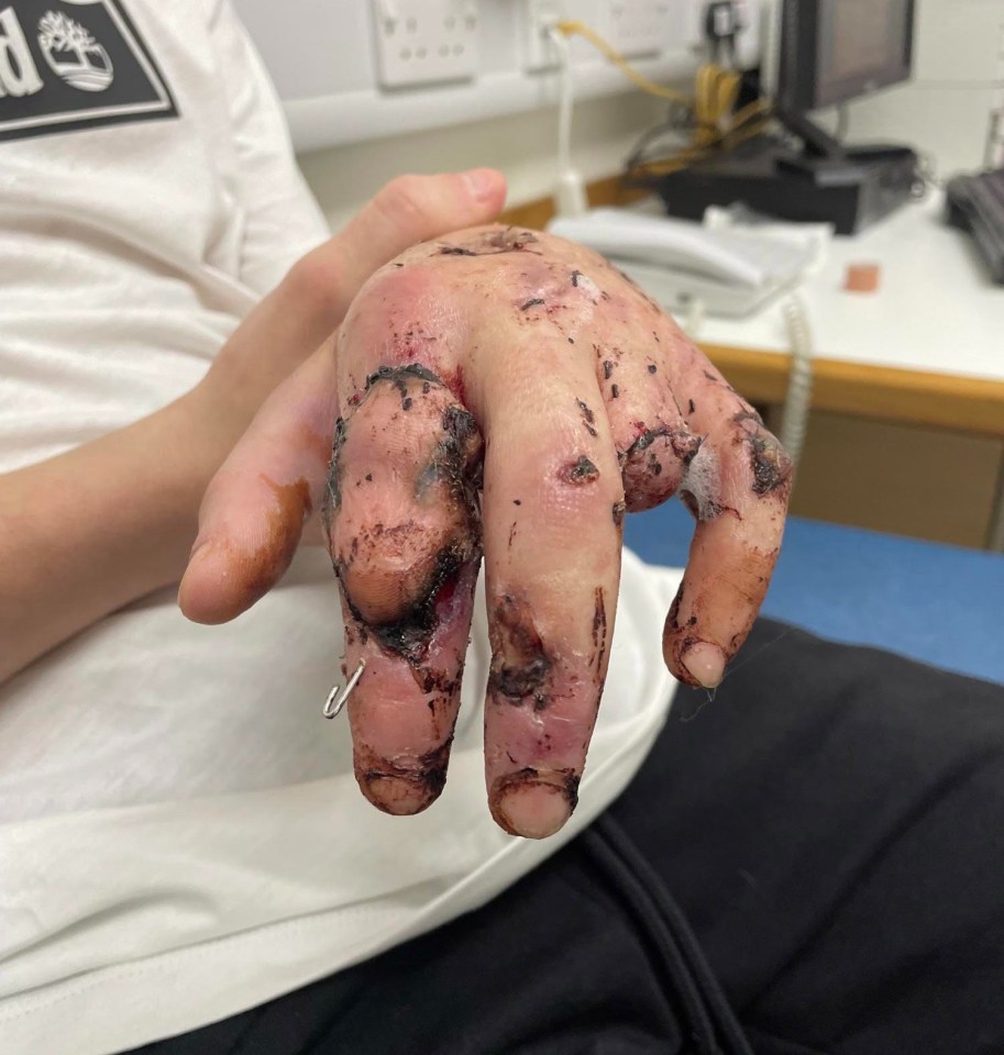 Jamie’s hand after the amputation