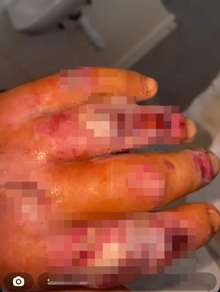 He developed a flesh-eating infection after suffering a small cut at work