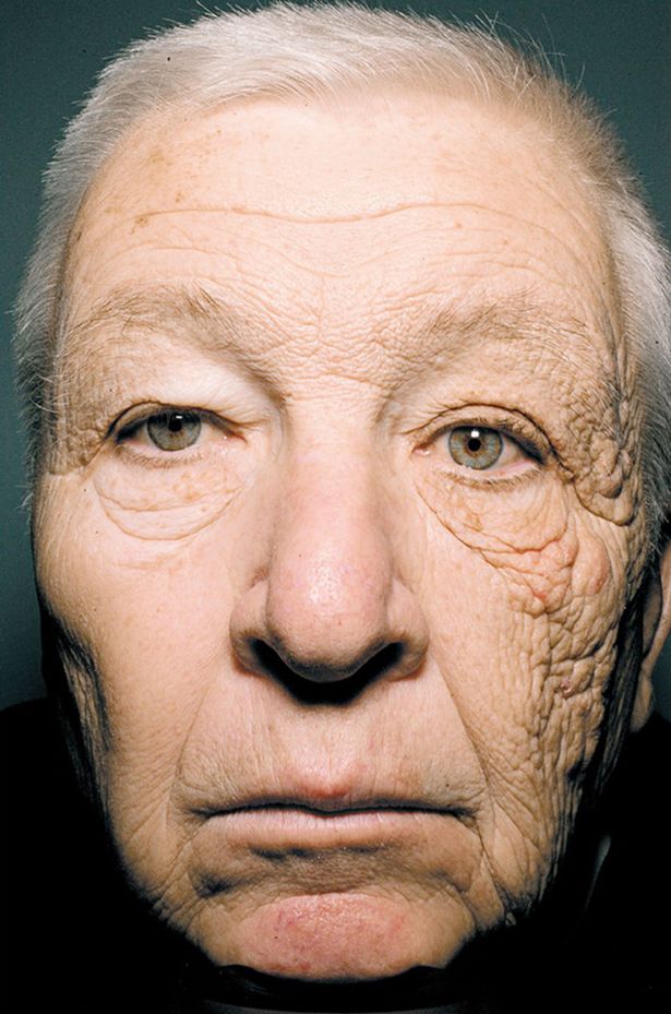 A truck driver’s sun-worn face has been used as the perfect example of what damage UV rays can do to the skin