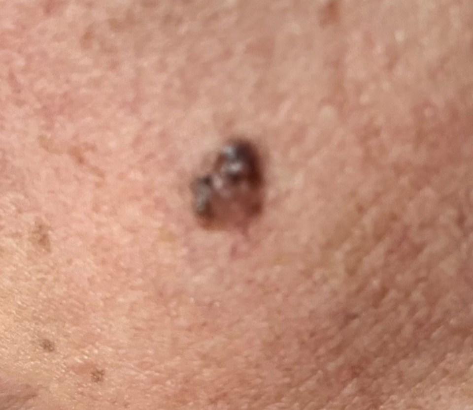 Michelle’s cancerous mole