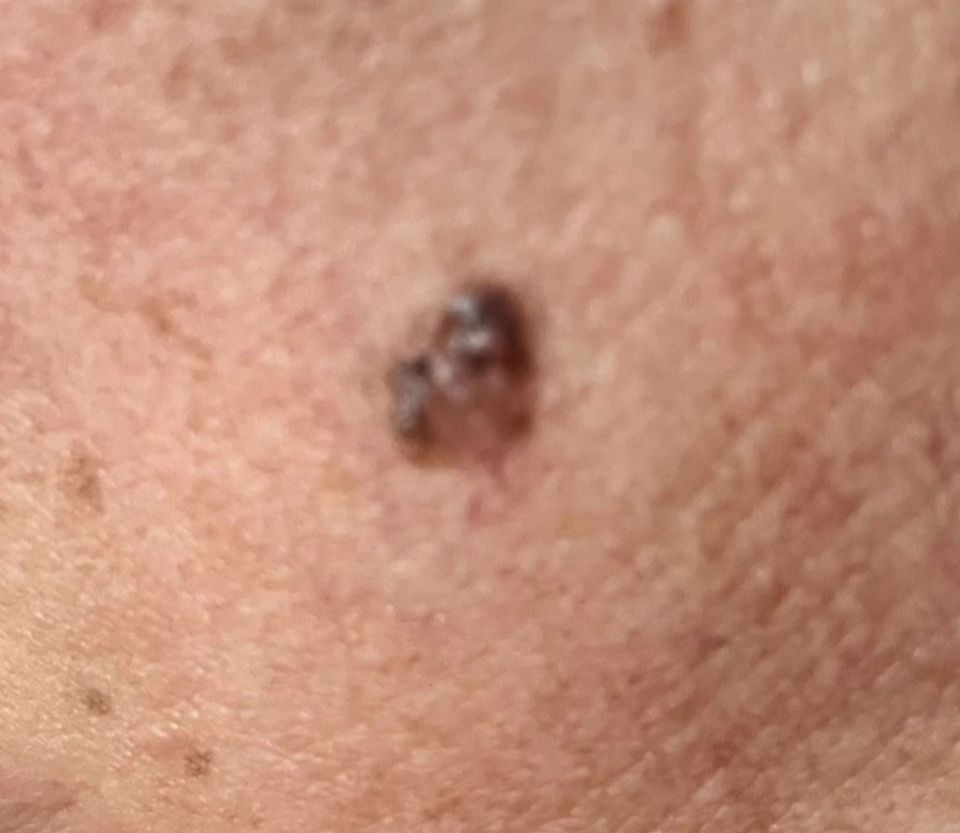 Michelle's cancerous mole