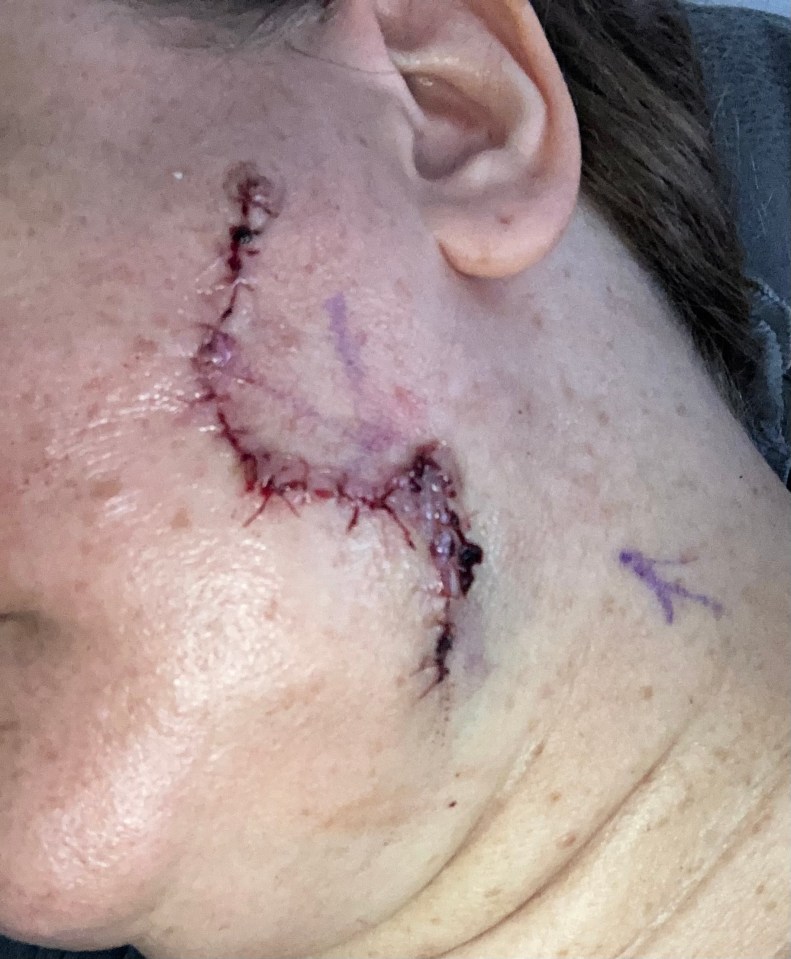 The 47-year-old was diagnosed with melanoma on her face