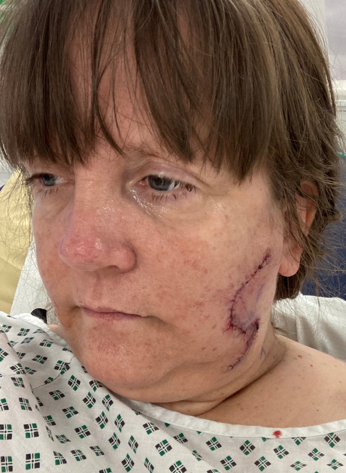 The life-saving surgery left her with a huge winding scar down the side of her face