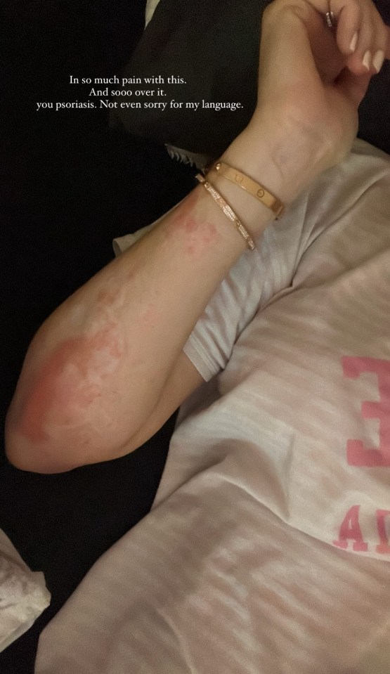 Jess shared a frustrated update with fans on her battle with psoriasis