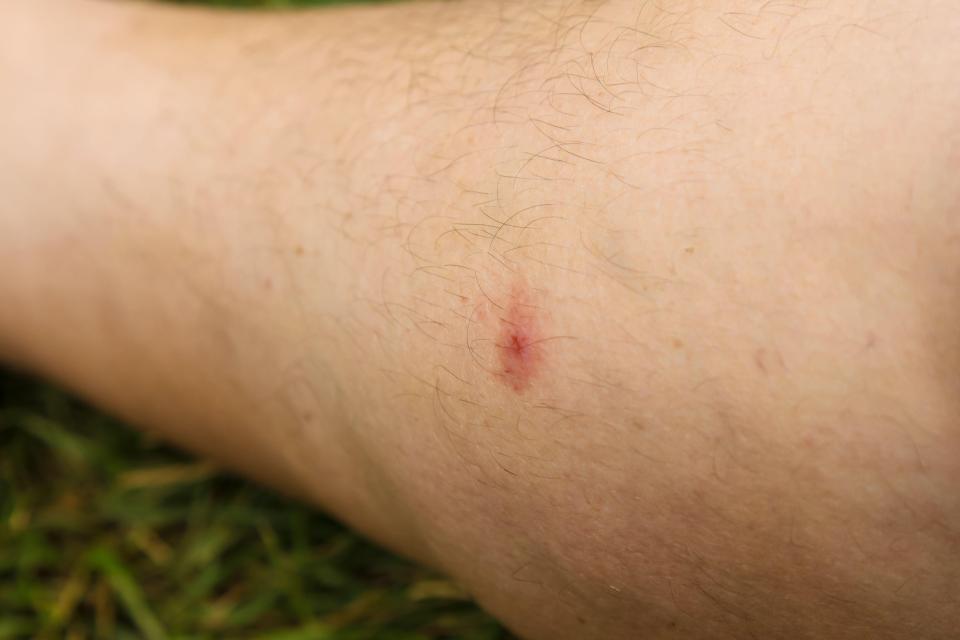 Gnat bite often appear as small, itchy and red bumps that sometimes bleed