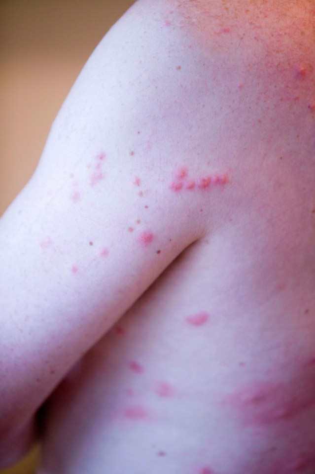 Midge bites can case painful blisters and sores