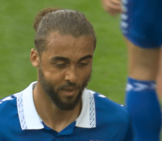 Dominic Calvert-Lewin was forced off with a heavily swollen cheek