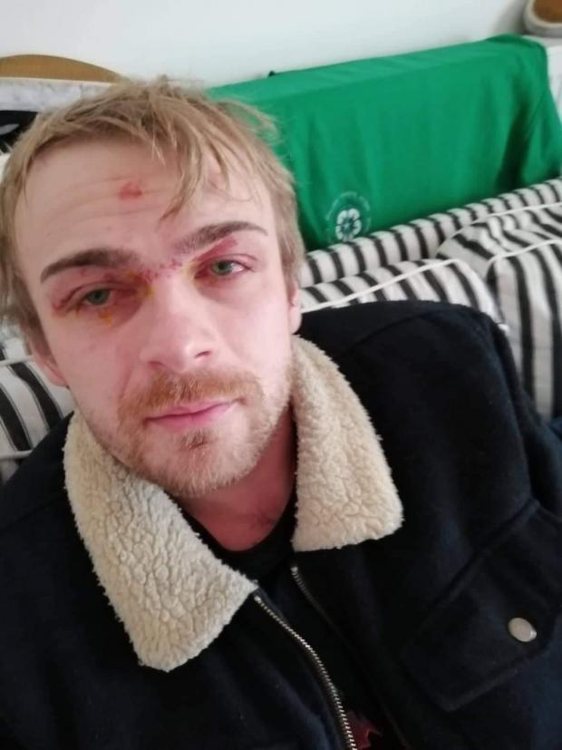 Local barman Tommy Powell after an 'acid' substance was thrown in his face