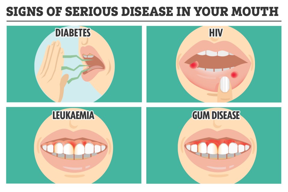 Most people are unaware of disease that can be spotted in the mouth