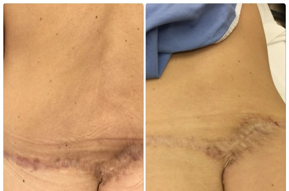 Dale was advised to have laser removal to fade the scarring, but caught the nurse editing the image to make the scars appear more faded (left image original, right edited)