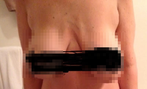 Dale wanted a natural look but was left feeling like a 'porn star' with uneven breasts