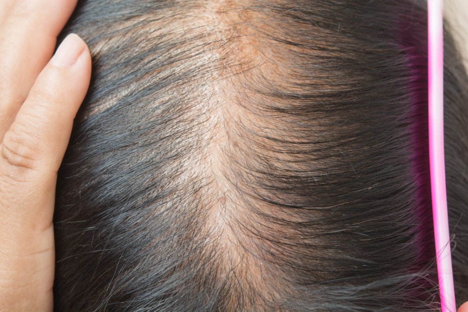 Hair loss can be difficult to go through but a 50p hack will prevent it