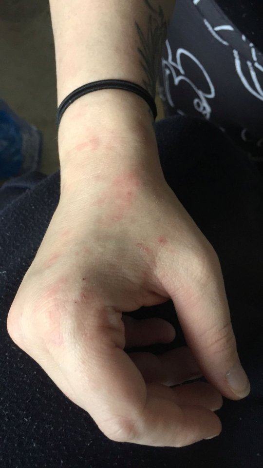 Bedbug bites on Chelsea Francis’ wrist