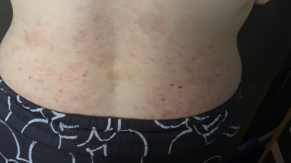 Bed Bug bites on Chelsea Francis’ lower back