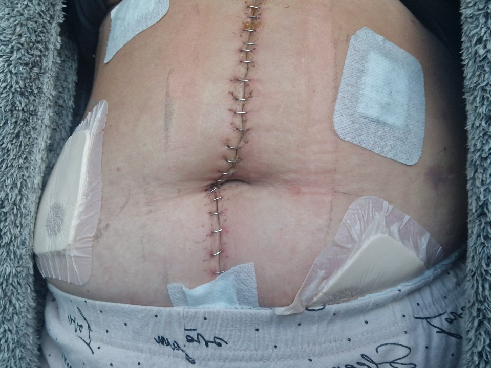 After her accident, Charlotte needed three operations, with doctors saving a quarter of her bowel