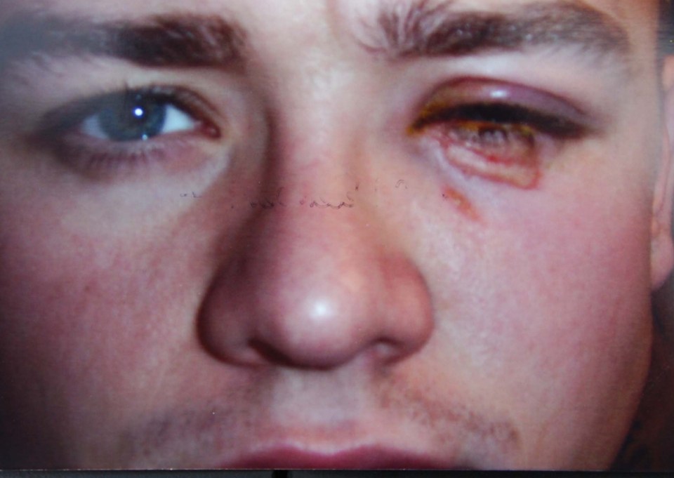 Jamie Tandy's eye was badly damaged after Joey Barton hit him with a lit cigar