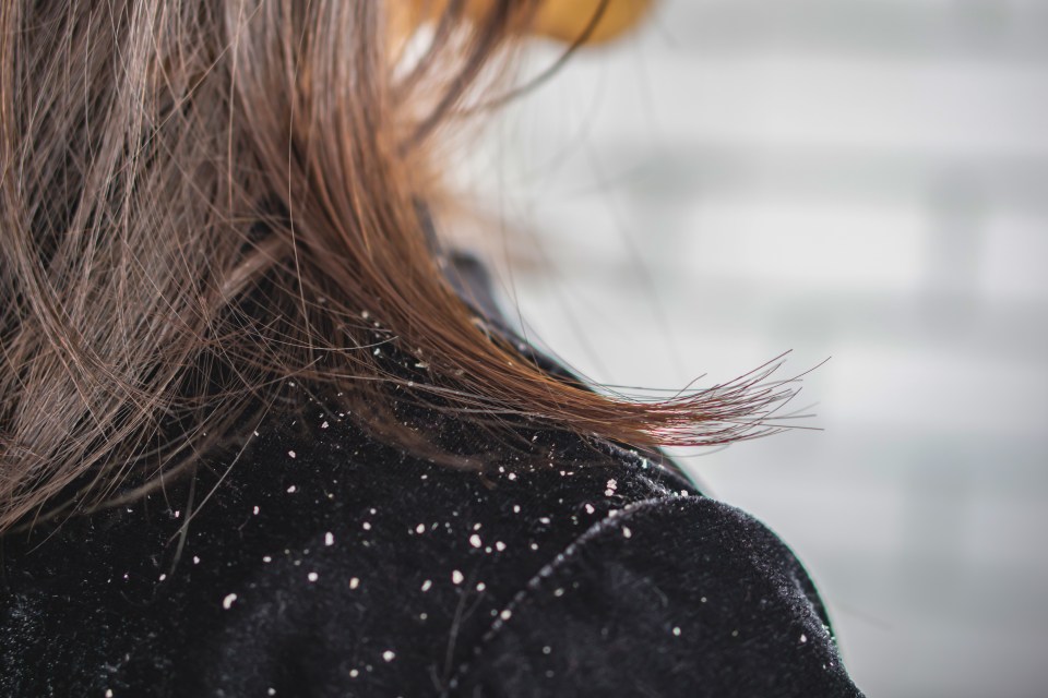 Dandruff is never a look anyone wants to be seen in