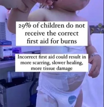 Not giving your little one the correct burn first aid could leave them scarred or slow the healing of their burn