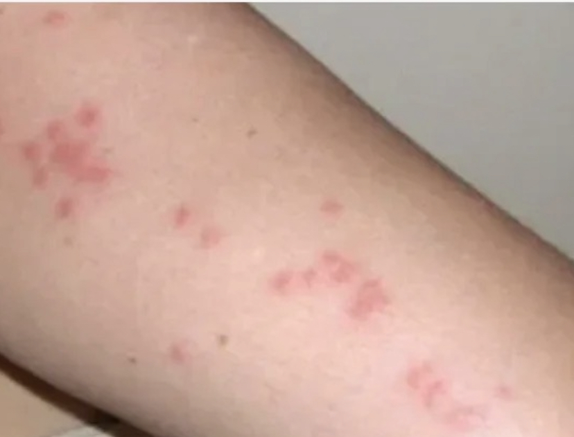 Bedbug bites are itchy and particularly distressing for children and pets