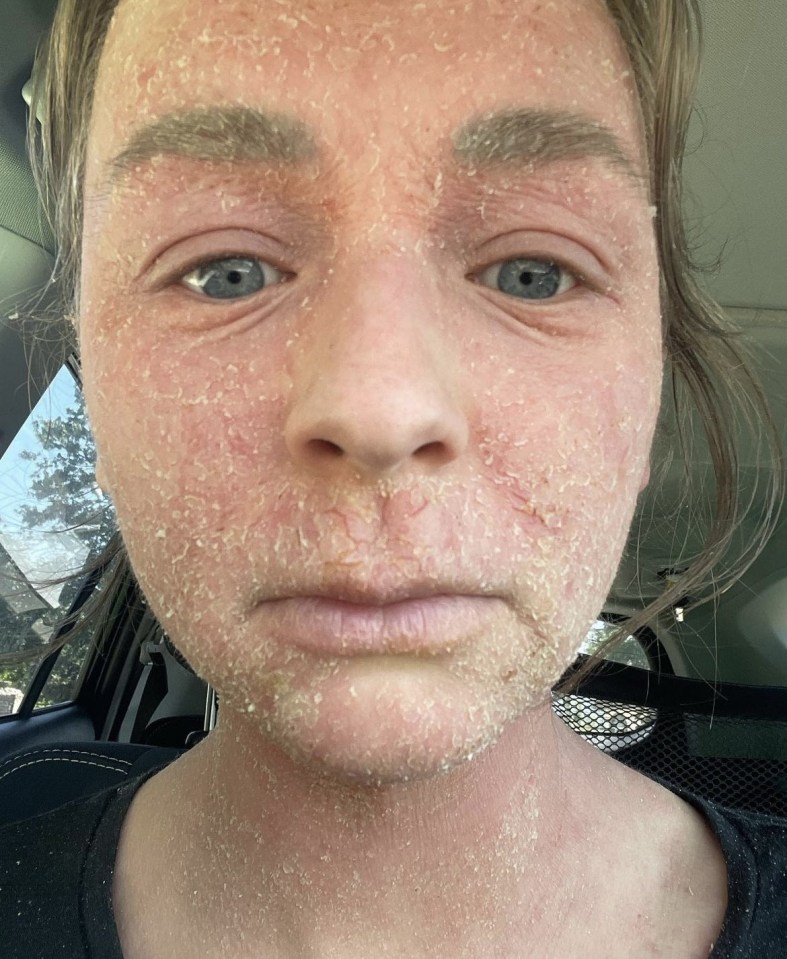 Amy Moldenhauer's skin flaked off while battling topical steroid withdrawal