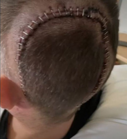 Dominic Matteo's head after surgery