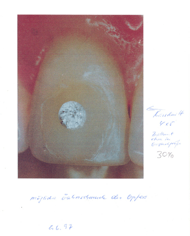 Cops released a picture of what they think her distinctive tooth gem - which was removed - could've looked like