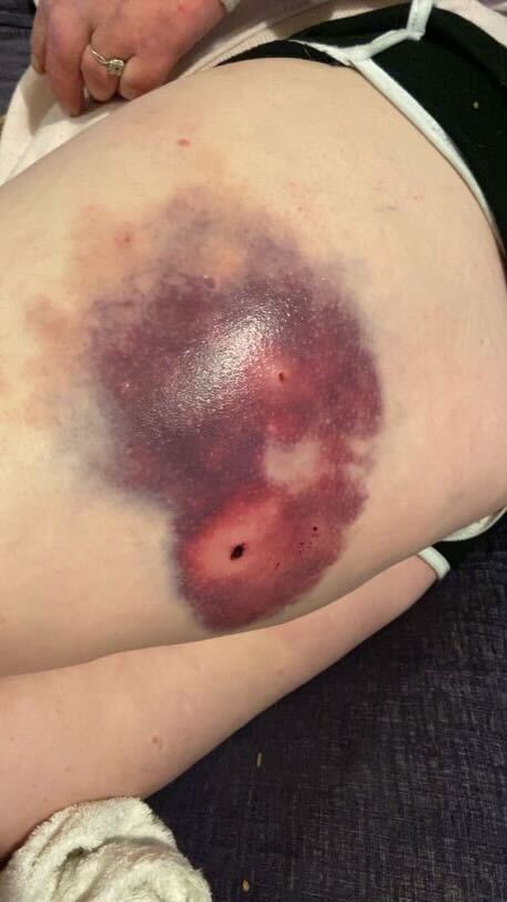 Envie delivered nasty injuries on Lynsey including this bite on her thigh