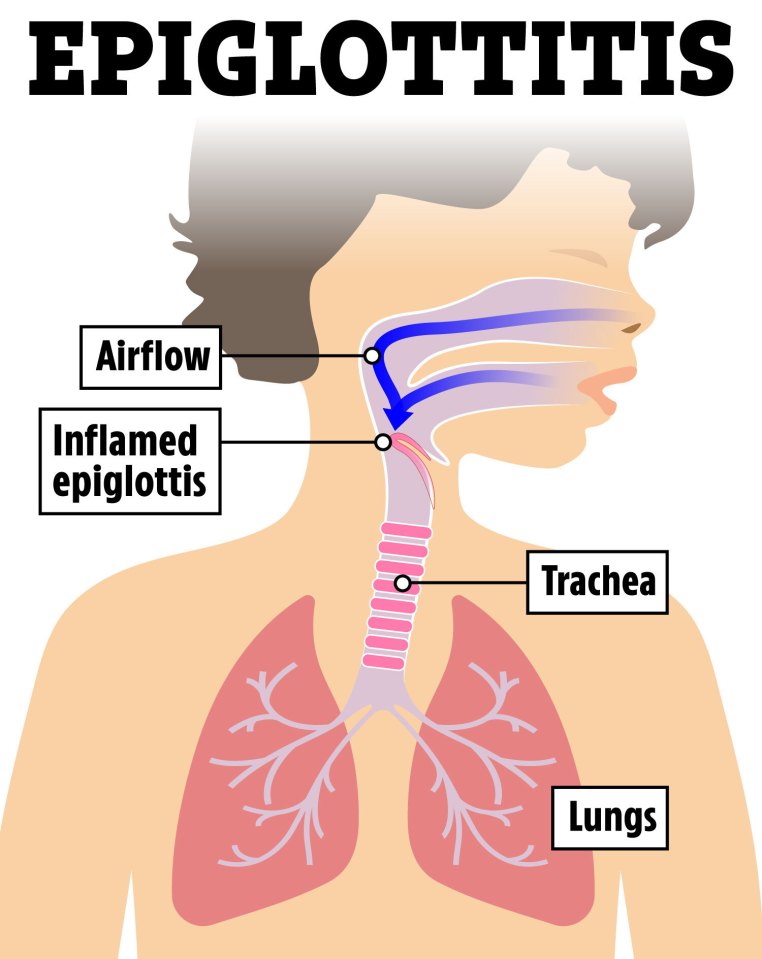 How epiglottitis affects the respiratory system