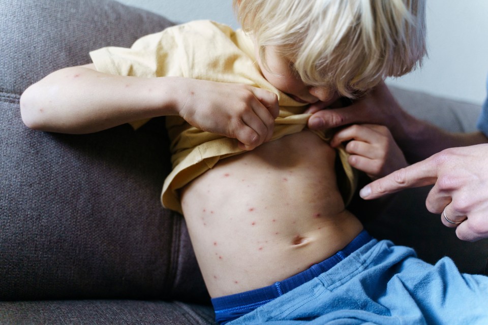 Chickenpox causes itchy spots, as well as other flu-like symptoms