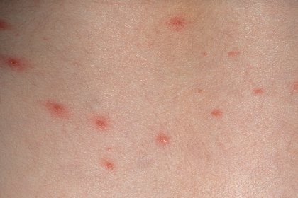 The first signs of chickenpox - small red spots anywhere on the body